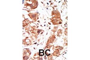 Formalin-fixed and paraffin-embedded human cancer tissue reacted with the PIM1 polyclonal antibody  , which was peroxidase-conjugated to the secondary antibody, followed by DAB staining. (PIM1 Antikörper  (C-Term))