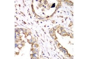 Immunohistochemistry of paraffin-embedded human liver cancer using HADHA antibody.