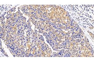 Detection of MAPK14 in Human Breast cancer Tissue using Polyclonal Antibody to Mitogen Activated Protein Kinase 14 (MAPK14) (MAPK14 Antikörper  (AA 19-279))