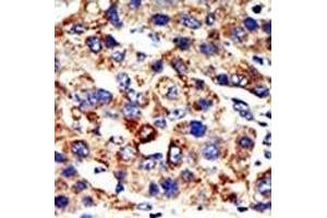 Formalin-fixed and paraffin-embedded human cancer tissue reacted with the primary antibody, which was peroxidase-conjugated to the secondary antibody, followed by AEC staining. (HDAC8 Antikörper  (N-Term))