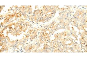 Immunohistochemistry of paraffin-embedded Human gastric cancer tissue using SOCS6 Polyclonal Antibody at dilution 1:50 (SOCS6 Antikörper)