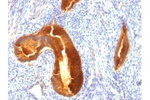 Formalin-fixed, paraffin-embedded human Endometrial Carcinoma stained with MUC-1 / CA15-3 / EMA Mouse Monoclonal Antibody (MUC1/955). (MUC1 Antikörper)