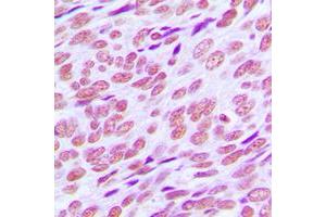 Immunohistochemical analysis of Cyclin E1 staining in human breast cancer formalin fixed paraffin embedded tissue section. (Cyclin E1 Antikörper  (C-Term))
