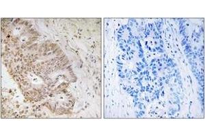 Immunohistochemistry analysis of paraffin-embedded human colon carcinoma tissue, using ZNF592 Antibody. (ZNF592 Antikörper  (AA 961-1010))