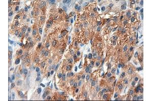 Immunohistochemical staining of paraffin-embedded Carcinoma of liver using anti-PTCH1 (ABIN2452537) mouse monoclonal antibody. (Patched 1 Antikörper  (AA 122-436))