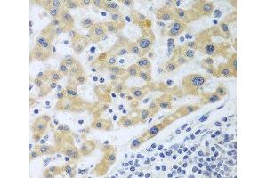 Immunohistochemistry of paraffin-embedded Human liver cancer using SHBG Polyclonal Antibody at dilution of 1:100 (40x lens). (SHBG Antikörper)