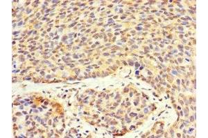 Immunohistochemistry of paraffin-embedded human ovarian cancer using ABIN7175332 at dilution of 1:100