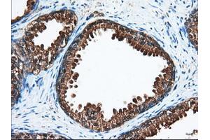 Immunohistochemical staining of paraffin-embedded Adenocarcinoma of Human ovary tissue using anti-ACAT2 mouse monoclonal antibody. (ACAT2 Antikörper)