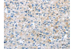 The image on the left is immunohistochemistry of paraffin-embedded Human liver cancer tissue using ABIN7192908(TRIM47 Antibody) at dilution 1/20, on the right is treated with synthetic peptide. (TRIM47 Antikörper)