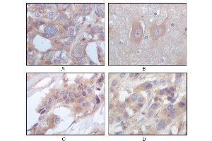Immunohistochemical analysis of paraffin-embedded human ovary carcinoma (A), normal cerebrum tissues (B), breast infiltrating carcinoma (C) and breast infiltrating carcinoma (D), showing cytoplasmic localization using STYK1/NOK mouse mAb with DAB staining.