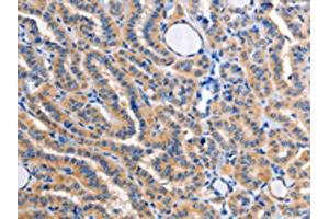 The image on the left is immunohistochemistry of paraffin-embedded Human thyroid cancer tissue using ABIN7128359(ALG8 Antibody) at dilution 1/30, on the right is treated with fusion protein. (ALG8 Antikörper)