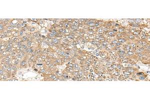 Immunohistochemistry of paraffin-embedded Human liver cancer tissue using C1orf101 Polyclonal Antibody at dilution of 1:65(x200) (C1orf101 Antikörper)