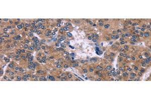 Immunohistochemistry of paraffin-embedded Human liver cancer tissue using SKI Polyclonal Antibody at dilution 1:40 (SKI Antikörper)