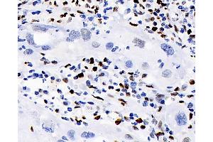 Immunohistochemistry analysis of paraffin-embedded human lymphoma using ERK 2 Polyclonal Antibody at dilution of 1:100. (ERK2 Antikörper)