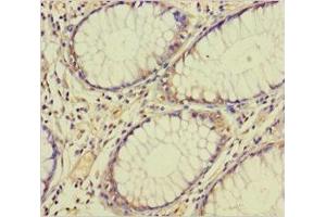 Immunohistochemistry of paraffin-embedded human colon cancer using ABIN7172672 at dilution of 1:100 (TAF12 Antikörper  (AA 1-161))