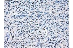 Immunohistochemical staining of paraffin-embedded Adenocarcinoma of colon tissue using anti-FOSL1mouse monoclonal antibody. (FOSL1 Antikörper)