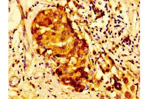 Immunohistochemistry of paraffin-embedded human breast cancer using ABIN7147000 at dilution of 1:100 (Cathepsin D Antikörper  (AA 67-403))