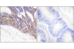 Immunohistochemistry analysis of paraffin-embedded human colon carcinoma, using LAT (Phospho-Tyr191) Antibody. (LAT Antikörper  (pTyr191))