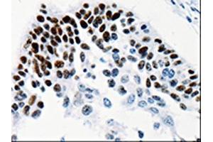 The image on the left is immunohistochemistry of paraffin-embedded Human cervical cancer tissue using ABIN7131338(TGIF2LX Antibody) at dilution 1/25, on the right is treated with fusion protein. (TGIF2LX Antikörper)