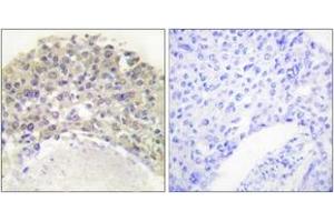 Immunohistochemistry analysis of paraffin-embedded human breast carcinoma, using Shc (Phospho-Tyr349) Antibody. (SHC1 Antikörper  (pTyr349))