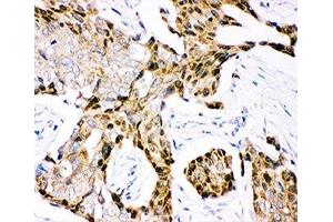 IHC-P: Ubiquitin antibody testing of human mammary cancer tissue (Ubiquitin Antikörper  (AA 77-152))