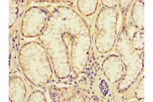 Immunohistochemistry of paraffin-embedded human gastric cancer using ABIN7161926 at dilution of 1:100 (NRIP3 Antikörper  (AA 1-241))