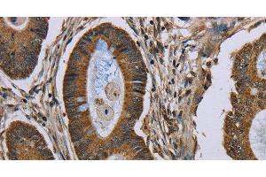 Immunohistochemistry of paraffin-embedded Human colon cancer tissue using NEFH Polyclonal Antibody at dilution 1:40 (NEFH Antikörper)