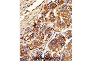 Formalin-fixed and paraffin-embedded human hepatocarcinoma with KLC1 Antibody (Center), which was peroxidase-conjugated to the secondary antibody, followed by DAB staining. (KLC1 Antikörper  (AA 389-415))