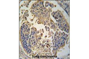 Formalin-fixed and paraffin-embedded human lung carcinoma tissue reacted with RIP3 (RIPK3) antibody , which was peroxidase-conjugated to the secondary antibody, followed by DAB staining. (RIPK3 Antikörper  (C-Term))