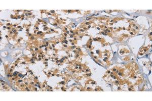 Immunohistochemistry of paraffin-embedded Human thyroid cancer tissue using IL12RB2 Polyclonal Antibody at dilution 1:40 (IL12RB2 Antikörper)
