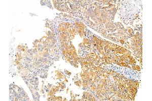 ABIN6260480 and ABIN6266502 at 1/100 staining Human liver cancer by IHC-P. (Caspase 10 Antikörper  (C-Term))