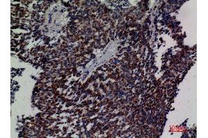 Immunohistochemistry (IHC) analysis of paraffin-embedded Human Lung Cancer, antibody was diluted at 1:100. (DCI Antikörper  (C-Term))