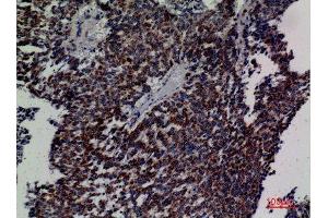 Immunohistochemistry (IHC) analysis of paraffin-embedded Human Lung Cancer, antibody was diluted at 1:100.