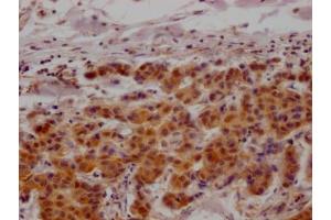IHC image of ABIN7127610 diluted at 1:100 and staining in paraffin-embedded human breast cancer performed on a Leica BondTM system.