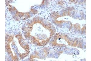 IHC testing of FFPE human ovarian carcinoma with LHR antibody (clone LHCGR/1417). (LHCGR Antikörper  (N-Term))