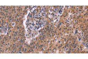 Immunohistochemistry of paraffin-embedded Human liver cancer tissue using HSD11B2 Polyclonal Antibody at dilution 1:35 (HSD11B2 Antikörper)