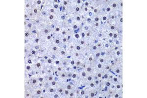 Immunohistochemistry of paraffin-embedded human liver cancer using GSTP1 antibody (ABIN5973328) at dilution of 1/200 (40x lens). (GSTP1 Antikörper)