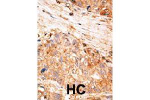 Formalin-fixed and paraffin-embedded human hepatocellular carcinoma tissue reacted with BIRC7 polyclonal antibody  , which was peroxidase-conjugated to the secondary antibody, followed by AEC staining. (BIRC7 Antikörper  (C-Term))