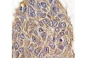 IHC analysis of FFPE human lung carcinoma tissue stained with Aldolase antibody (ALDOA Antikörper  (AA 66-95))