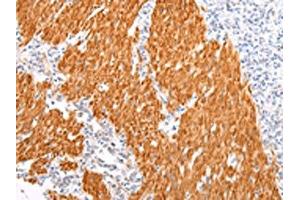 The image on the left is immunohistochemistry of paraffin-embedded Human gastric cancer tissue using ABIN7190022(BSN Antibody) at dilution 1/20, on the right is treated with synthetic peptide. (Bassoon Antikörper)