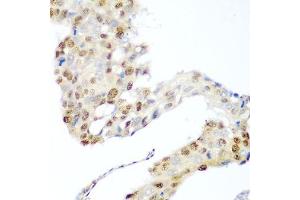 Immunohistochemistry of paraffin-embedded human lung cancer using CDK1 antibody. (CDK1 Antikörper  (AA 1-297))
