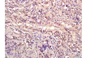 Formalin-fixed and paraffin embedded human lung carcinoma labeled with Anti-WNT9A Polyclonal Antibody, Unconjugated (ABIN675533) at 1:200 followed by conjugation to the secondary antibody and DAB staining (WNT9A Antikörper  (AA 21-120))