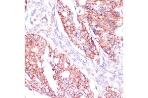 Immunohistochemistry of paraffin-embedded human colon carcinoma using RPL24 antibody (ABIN7269998) at dilution of 1:100 (40x lens). (RPL24 Antikörper  (AA 38-157))