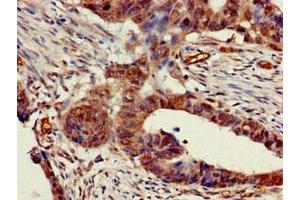 Immunohistochemistry of paraffin-embedded human colon cancer using ABIN7142959 at dilution of 1:100 (CHRNB1 Antikörper  (AA 24-244))