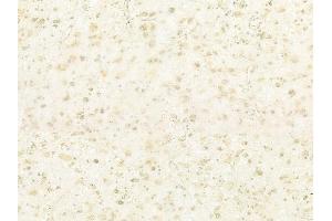ABIN6260727 and ABIN6278679 at 1/100 staining human astrocytoma by IHC-P. (CDKL5 Antikörper  (Internal Region))