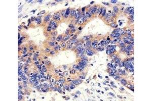 IHC analysis of FFPE human colon carcinoma section using anti-PCSK9 antibody; Ab was diluted at 1:100.
