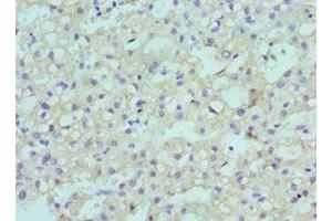 Immunohistochemistry of paraffin-embedded human liver cancer using ABIN7147709 at dilution of 1:100 (CBX8 Antikörper  (AA 80-280))