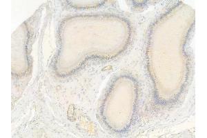 ABIN7093391 and ABIN7097412 at 1/100 staining human testicular cancer by IHC-P. (IRF7 Antikörper)