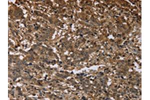 The image on the left is immunohistochemistry of paraffin-embedded Human liver cancer tissue using ABIN7191451(MFF Antibody) at dilution 1/25, on the right is treated with synthetic peptide. (MFF Antikörper)