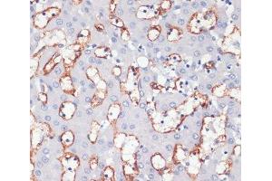Immunohistochemistry of paraffin-embedded Human liver cancer using CD36 Polyclonal Antibody at dilution of 1:200 (40x lens). (CD36 Antikörper)